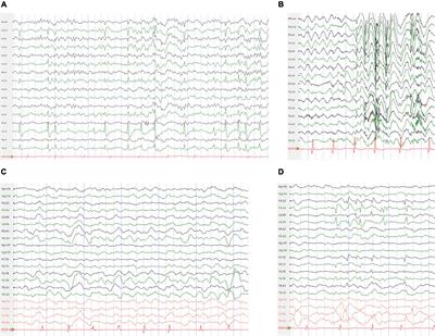 SCN1A-Related Epilepsy: Novel Mutations and Rare Phenotypes